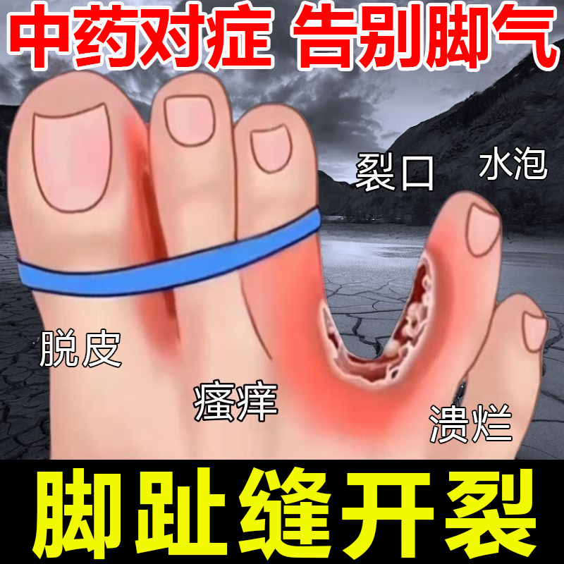 治脚气止痒脱皮杀菌克脚气硝酸咪康唑乳膏软膏正品的药烂脚丫糜烂