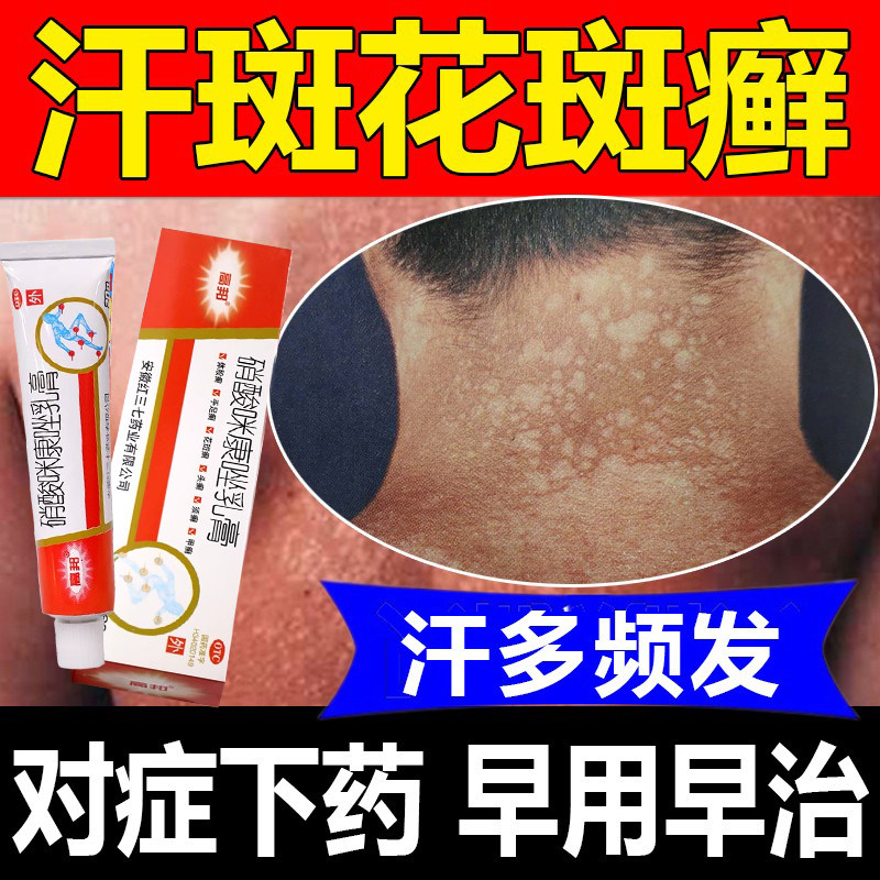 治汗斑花斑癣体股癣手足癣头癣皮肤真菌感染斑点专用药膏高邦正品