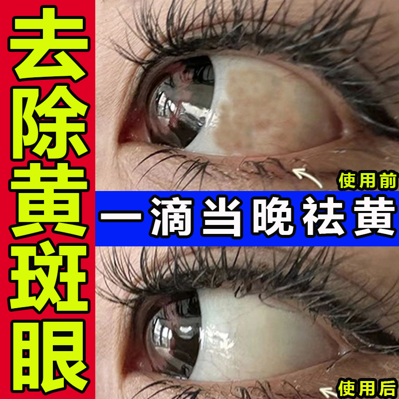 眼白清澈去黄混浊滴眼液黄斑病变眼睛模糊看不清药水去黄去红血丝