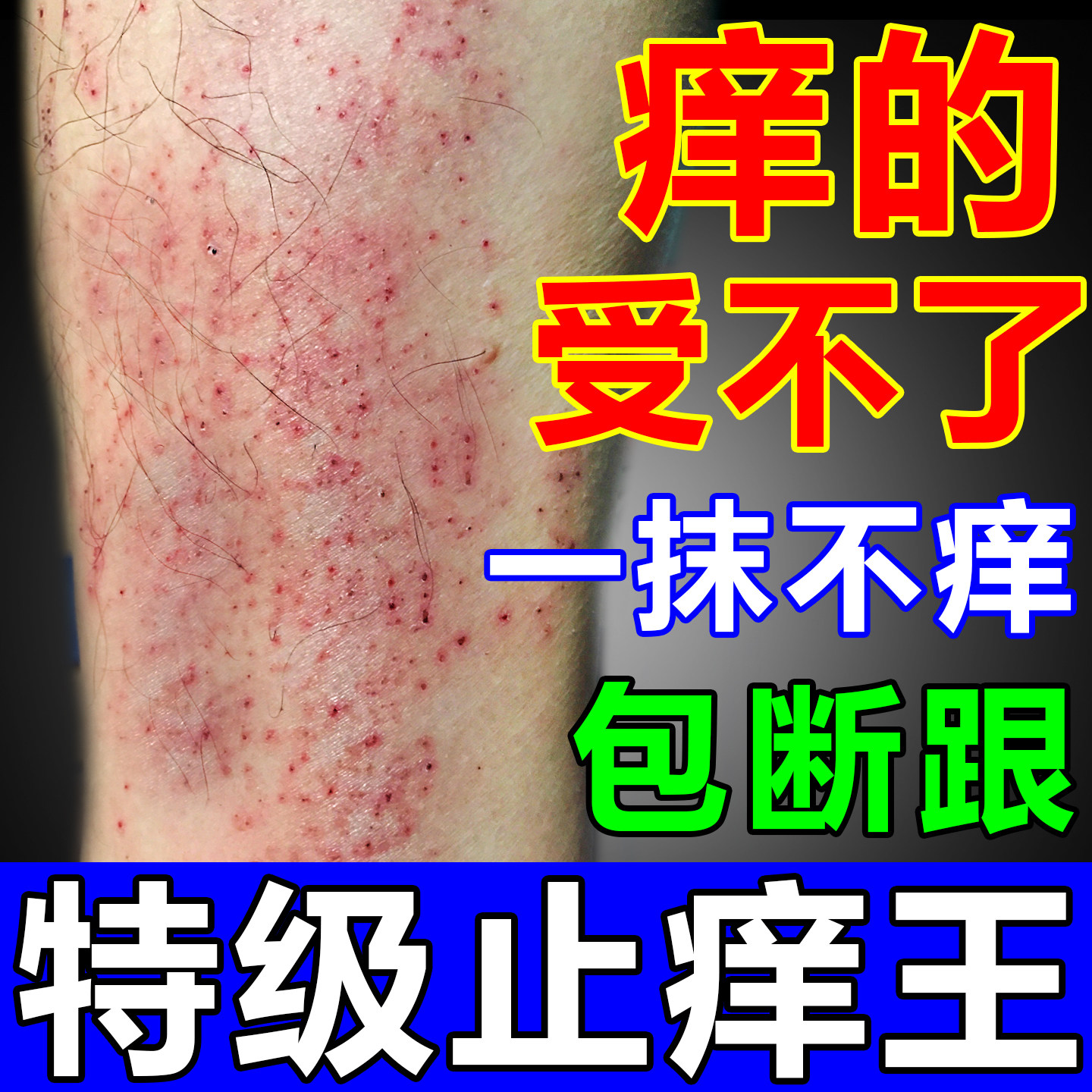 止痒特效皮肤瘙痒药湿外用根去苗家湿毒膏进口正品疹专用抑菌乳膏