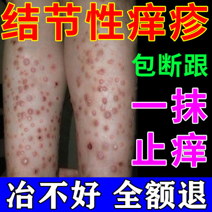 结节性痒疹特效治顽固硬疙瘩全身皮肤瘙痒红斑止痒抑菌专用膏外用