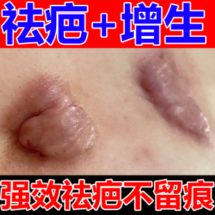 疤痕增生凸起去除胸前瘢痕疙瘩软化针修复油烫伤疤体质痒专用膏贴