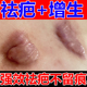 疤痕增生凸起去除胸前瘢痕疙瘩软化针修复油烫伤疤体质痒专用膏贴
