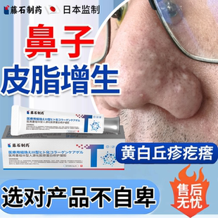 鼻子皮脂腺增生软膏鼻头鼻翼上肉疙瘩面部异位症去药房膏酒糟鼻YS