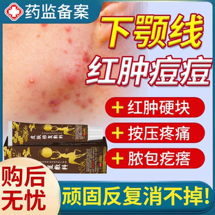 下颚线淋巴痘腮边痘专用结节药房膏红肿硬块痘痘贴消炎祛石头痘YS