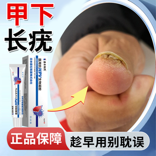 甲周疣专用膏指甲下长疣去儿童手指疣寻常疣瘊子肉刺药监备案膏YM
