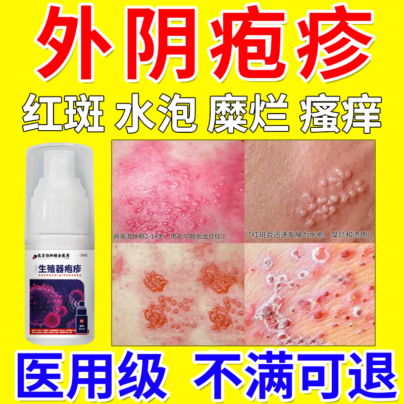 女性外阴生殖器疱疹断糜烂根溃疡可搭克星治疗药膏用私处小水泡wy