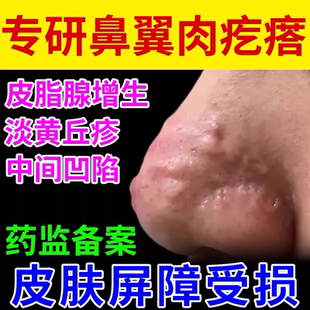 鼻翼鼻子上肉疙瘩除鼻头长消除皮脂腺增生贴分泌旺盛去除酒糟鼻YS