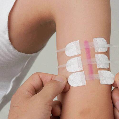 Band-Aid Zipper Tie Wound Closure Patch Hemostatic Patch Wou