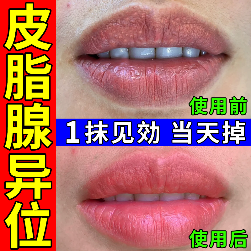 皮脂腺异位症嘴唇干裂起泡白点除去神器脂肪小颗粒增生唇部专用