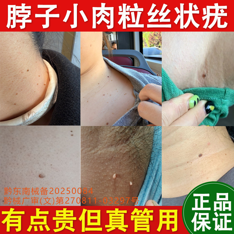 去脖子丝状疣小肉粒扁平疣祛除膏腋下肉刺疙瘩皮赘瘊子痦子去疣