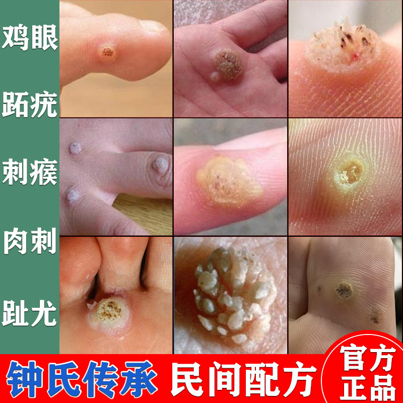 鸡眼膏去脚底鸡眼猴子跖疣鸡眼贴鸡贴眼膏手上刺猴肉刺专用去除膏