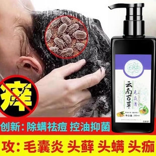 头部头皮屑癣头上长痘痘结痂可搭毛囊炎洗发水专用搭药膏中药克星