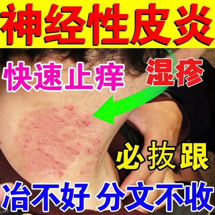神经性皮炎去祛根除外用膏治疗皮肤病癣藓湿疹顽固无激素真菌感染