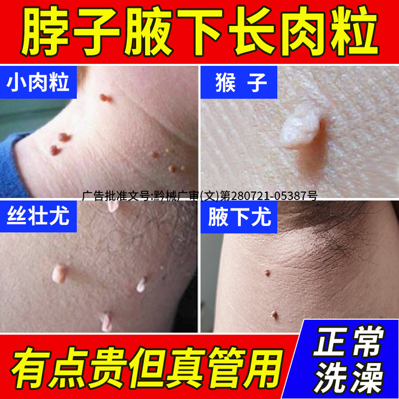 扁平疣猴子去除软膏一抹灵脖子上肉球去疣瘊小肉粒丝状疣疙瘩去除