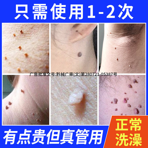 去疣瘊脖子上长小肉粒皮赘扁平疣一抹灵猴子丝状疣肉球疙瘩点疣膏