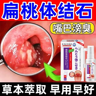 扁桃体结石去除工具隐窝冲洗器清理口腔咽喉臭漱口水喷剂吸引神器
