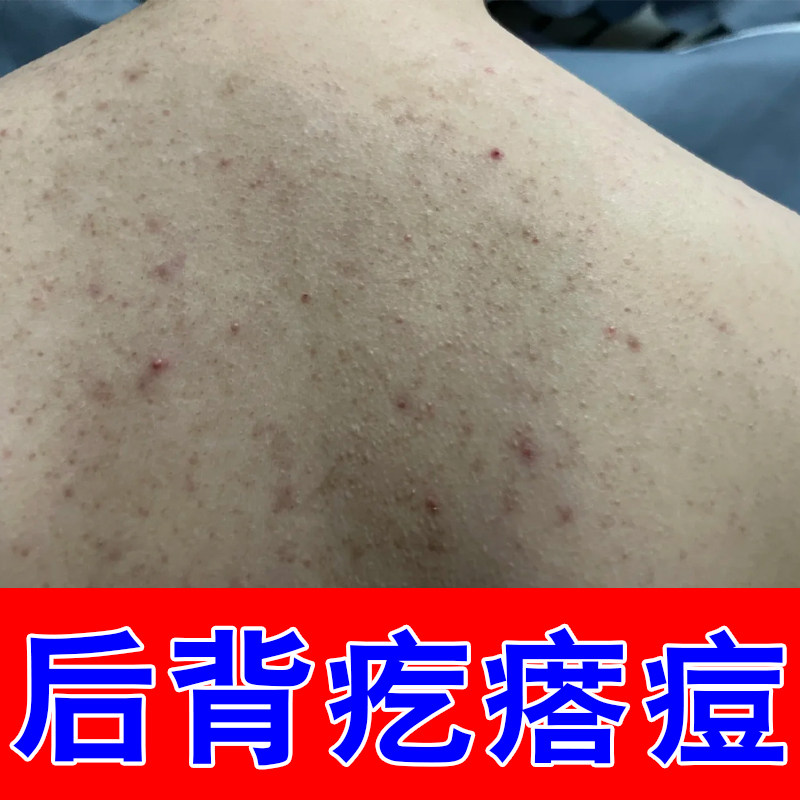 背上长痘痘毛囊痘痒马拉色菌前胸皮肤消毒护理（消）