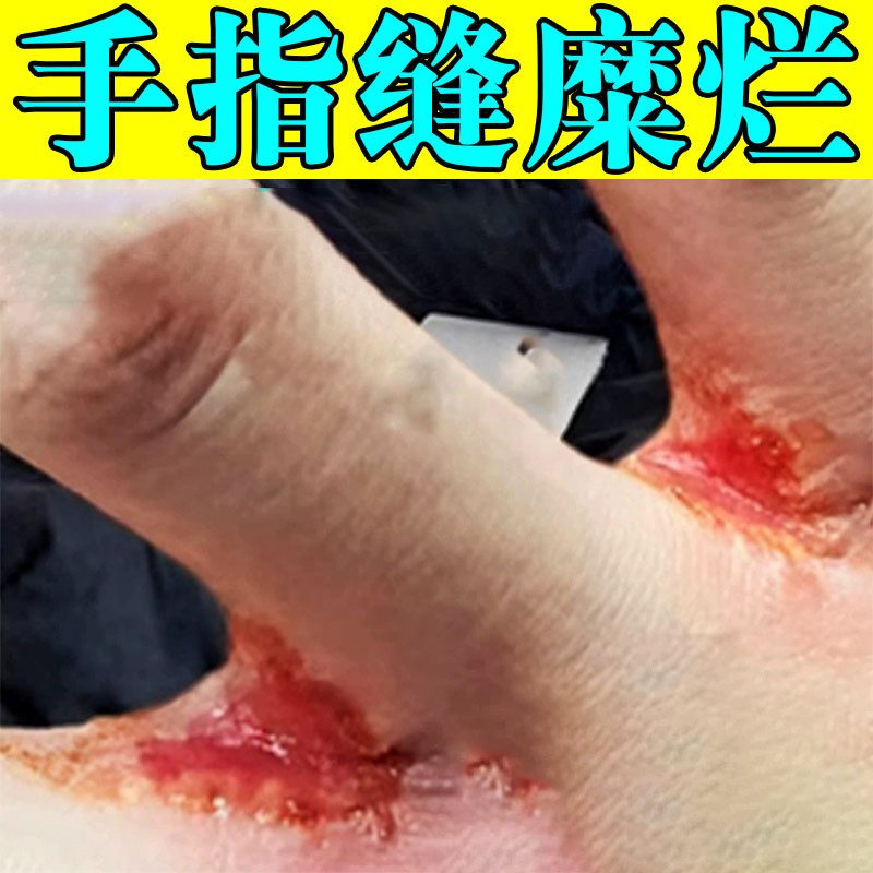 烂手丫专药用膏手指缝溃烂脱皮手气裂口经常碰水泛红刺痛杀菌软膏