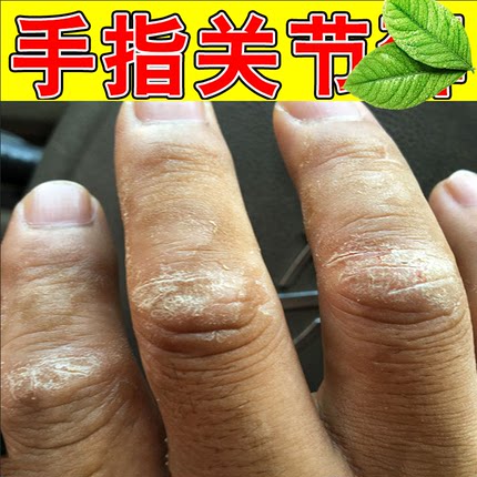 手指关节起皮手指关节长硬疙瘩伤脱皮干裂干裂