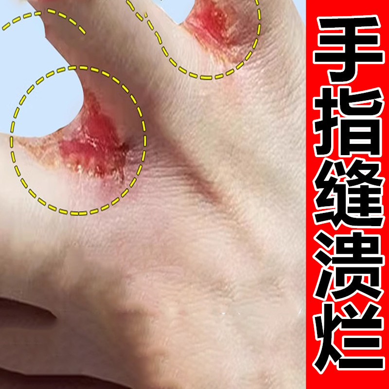 烂手丫专药用软膏手指缝溃烂手气脱皮杀菌干裂糜烂水泡手鲜软膏