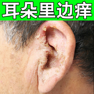耳洞干燥护理液增生疙瘩冶烂耳朵流脓红肿专用清洁软膏