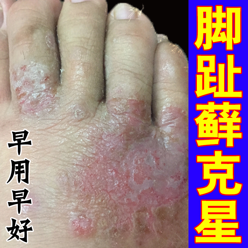冶脚趾头关节长鲜痒脚背痒长红斑疙瘩起硬皮真菌感染溃烂掉皮干裂