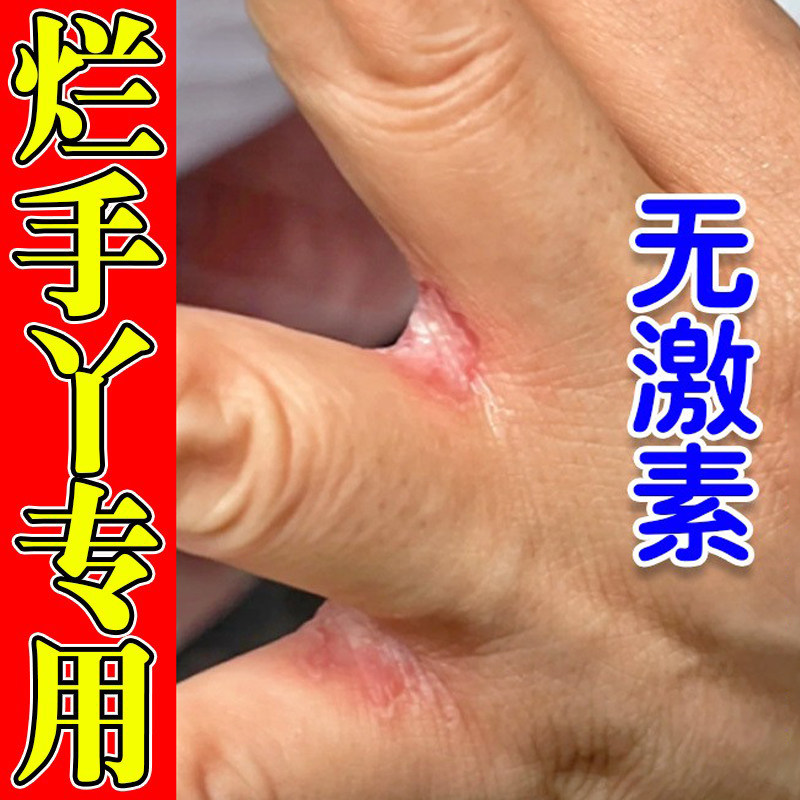 烂手丫专药用手指缝溃烂糜烂修复膏指间经常碰水痒软膏