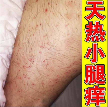 夏天天气热腿上起疙瘩长红点皮肤燥起皮软膏