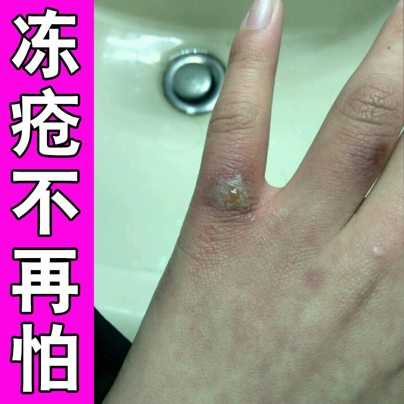冬季手冻伤冻疮膏耳朵手指冻伤裂口脚后跟干裂起硬皮足跟开裂修护