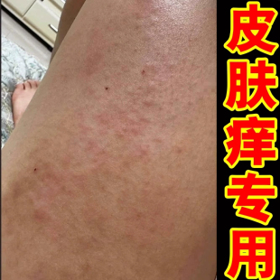 腿上长小红疙瘩过敏干燥起皮刺挠掉皮屑外用膏