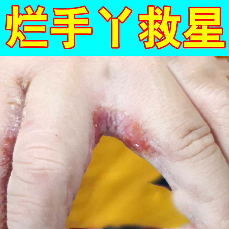 手指缝溃烂经常碰水烂手丫糜烂干裂疼痛真菌感染手鲜专用软膏