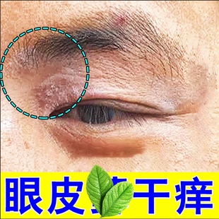 眼皮红肿干燥起皮眼周上眼睑红肿掉皮屑眼角脂溢软膏