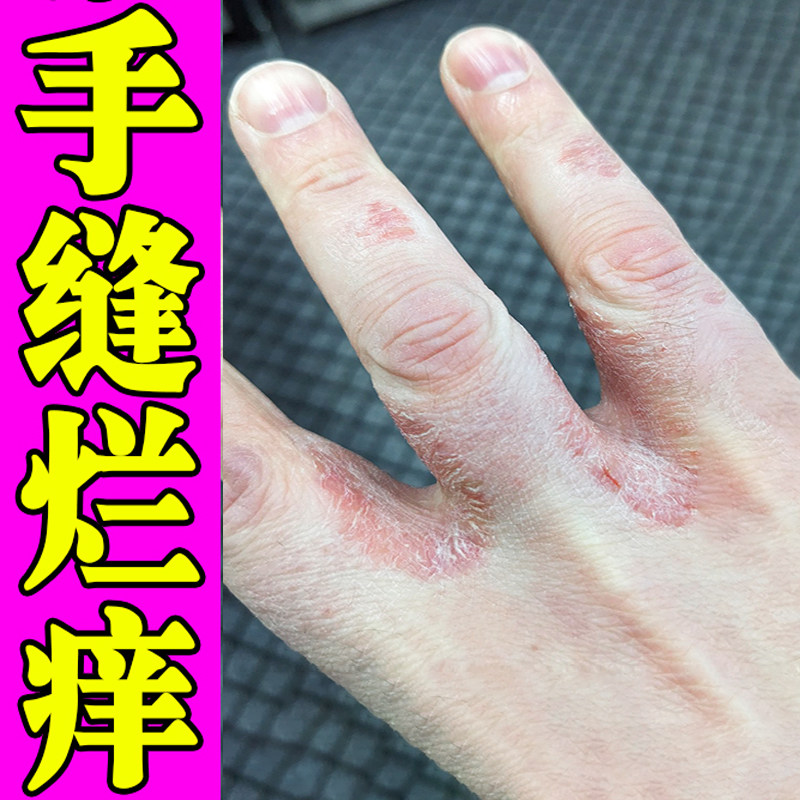 烂手丫专药用手指缝溃烂软膏手气脱皮杀菌鲜真菌感染软膏