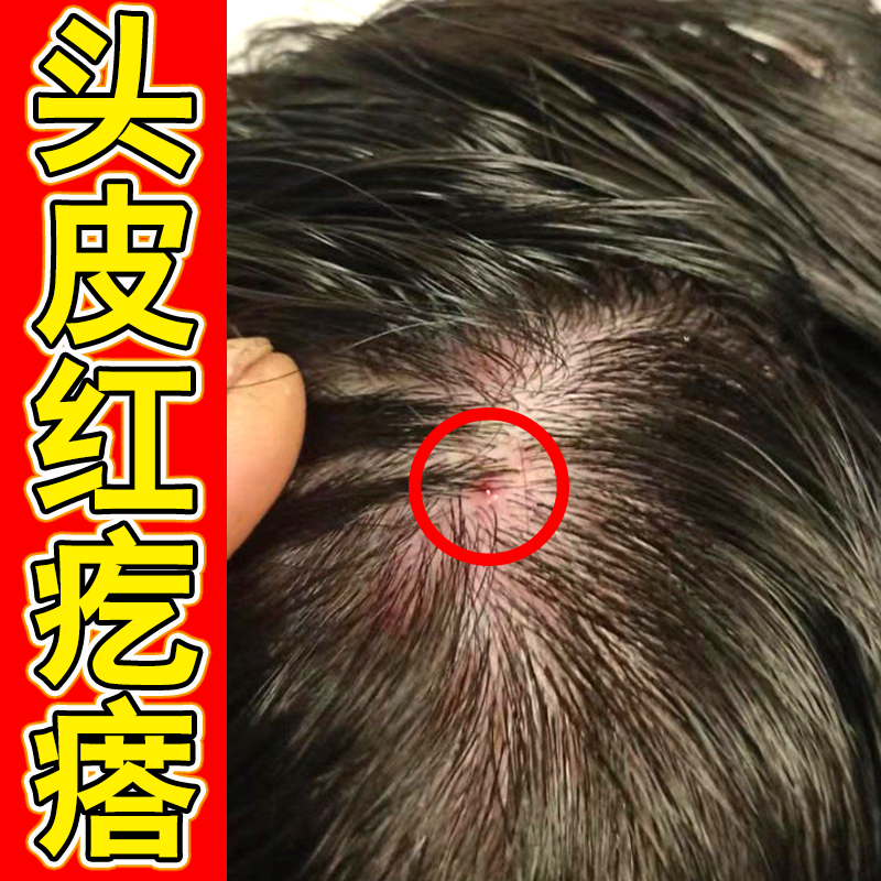 冶疗毛囊炎专用头部头皮痒有疙瘩前胸后背头上脸上长豆豆专用软膏