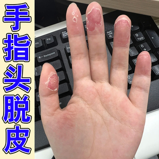 手脱皮小孩手指头蜕皮手掌心脱皮指甲边缘发干发硬外用膏