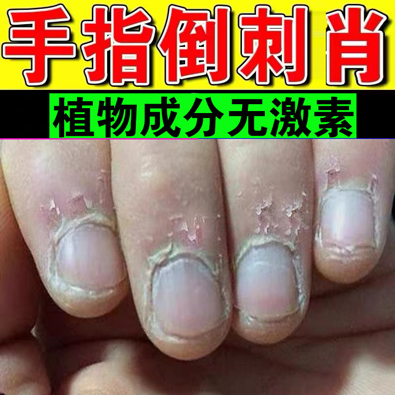 指甲修复液手指倒刺营养油护理去刺神器防止儿童手上长边缘干裂霜