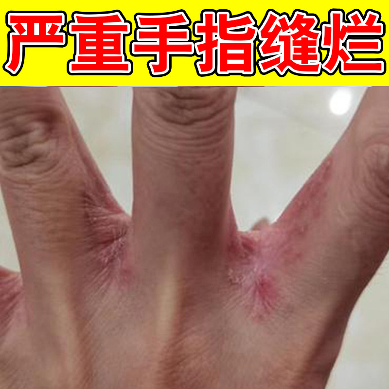 手指缝溃烂洗洁精敏过膏药冶疗烂手丫糜烂疼起水泡真菌软膏