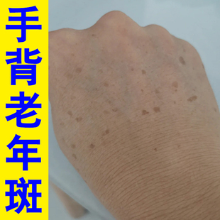手背上老年斑褐色斑老年斑专用手上脸部黄褐斑日晒斑皮肤上黑斑膏
