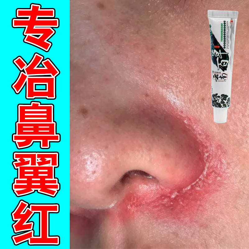 鼻子两侧发红皮鼻翼两边泛红干燥皮肤消毒护理（消）