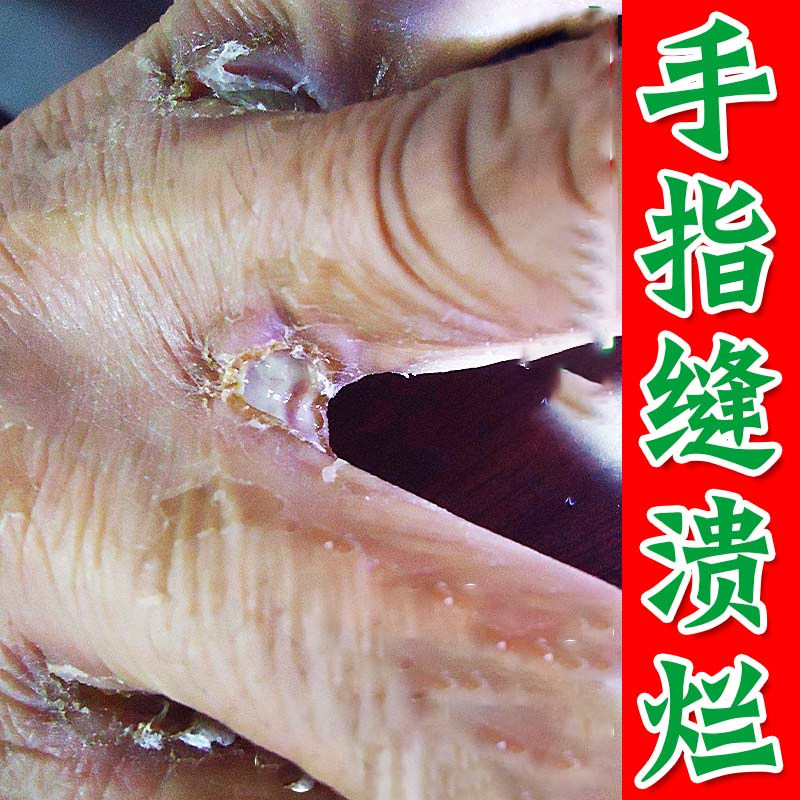 烂手丫药手指缝溃烂经常碰水脱皮长水泡发红干裂口手鲜专药用软膏