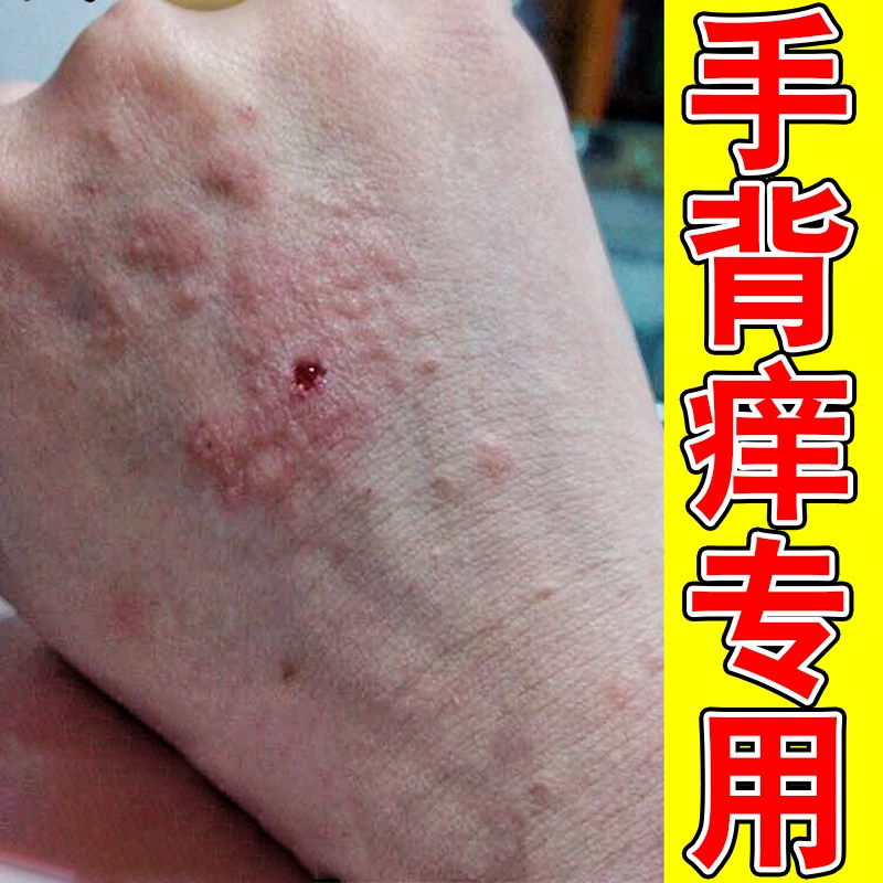 手背手背上长小疙瘩紫外线晒伤手皮肤消毒护理（消）