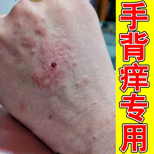 手背手背上长小疙瘩紫外线晒伤手上起疙瘩红点修复软膏