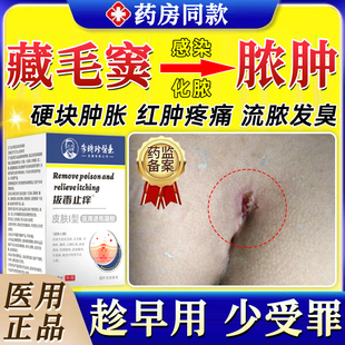 藏毛窦药膏感染化脓脓肿囊肿骶骨尾肛门硬疙瘩坐疮毛囊炎拔毒拔GX