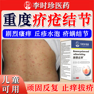 疥螨结节杀虫剂疥疮药膏疥苍膏阴囊硫磺软膏疥虫儿童沐浴露喷雾TT