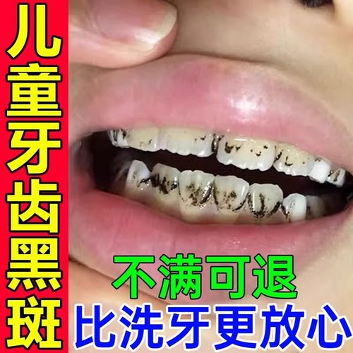 儿童牙齿黑色素沉淀去牙菌斑牙膏黑线黑斑黑渍污垢祛除神器美白GX