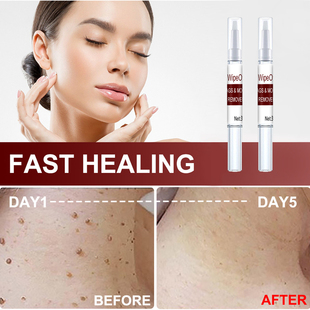 极速2pcs Warts Remover Ltiquid Skin Tag Remover Antibacteria