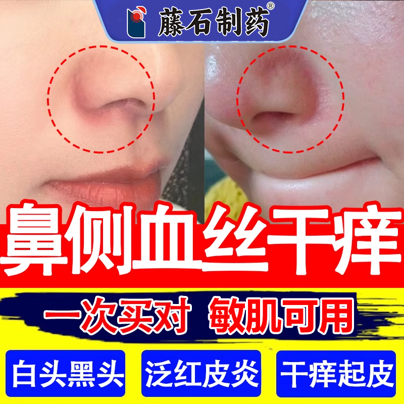 鼻翼两侧泛红血丝脂溢性皮炎脱皮油脂干痒黑白头粉刺酒糟鼻软膏wg