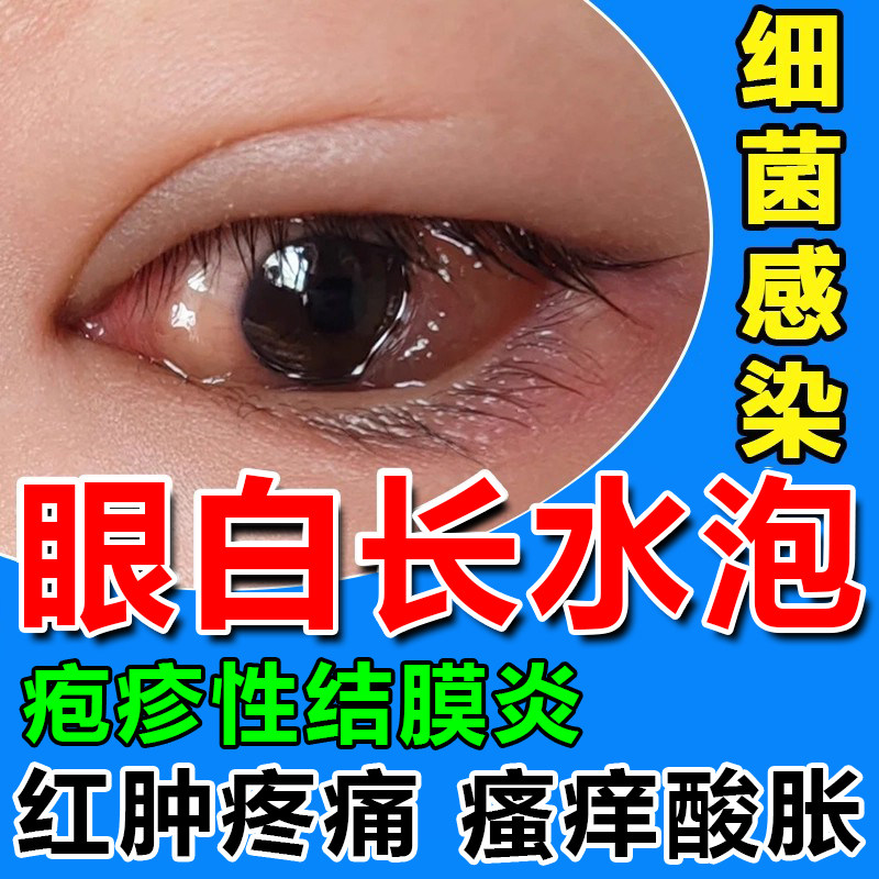 疱疹性结膜炎眼白长水泡息肉去红血丝瘙痒眼睛浑浊叶黄素液wg
