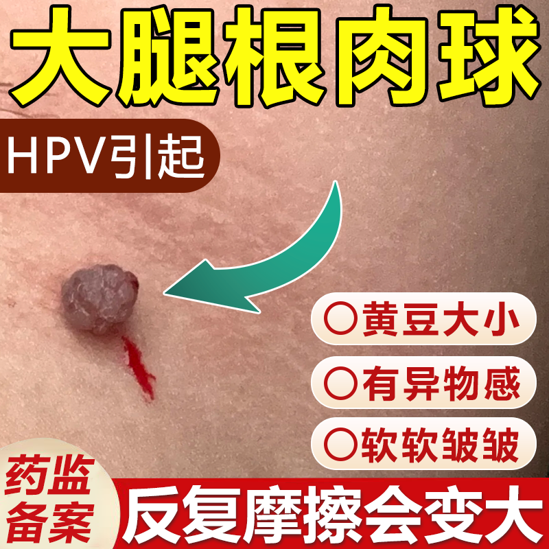 大腿根部皮赘小肉粒球皮肤纤维瘤